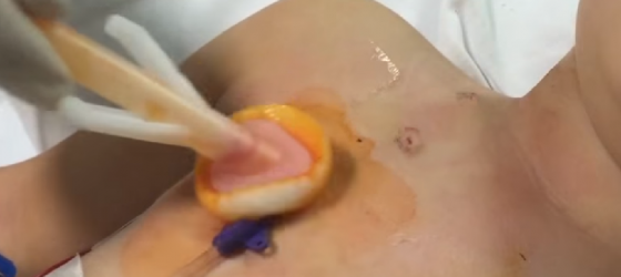 Accesso vascolare nel bambino